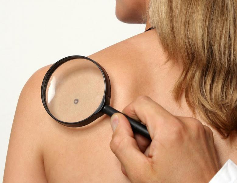 Опасные родинки – под контроль